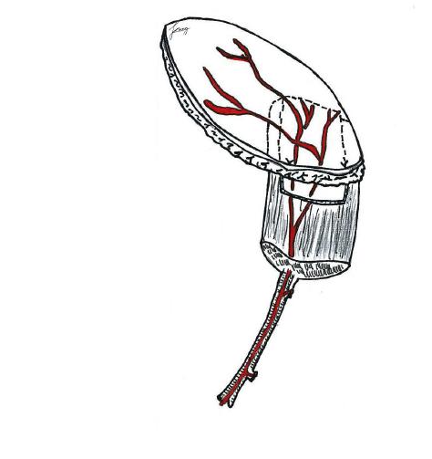 Schematic drawing of elevated rectus abdominis free flap with oblique skin paddle including myocutaneous perforator from deep inferior epigastric vessels.