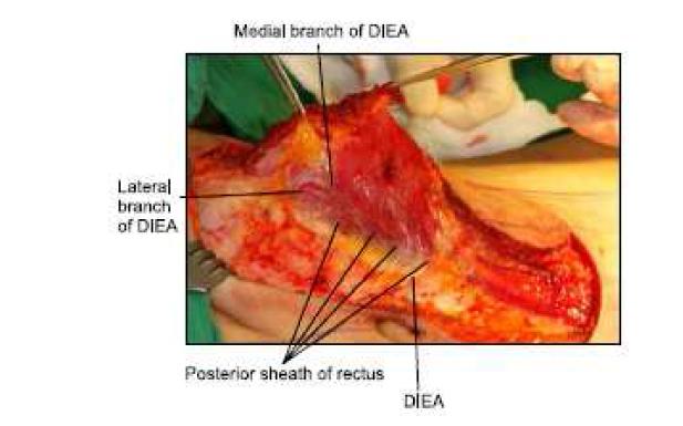 Clinical view of medial and lateralbranch of the deep inferior epigastric artery