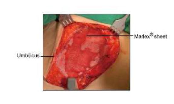 Clinical view of Marlex sheet® (Monofilament polyprophylene) for the coverage of the lower area of arcuate line.