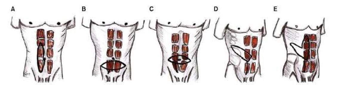 Representative five skin patterns of the myocutaneous rectus abdominis free flap. (A) Vertical,