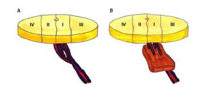 Schematic drawing of skin boundaries of zone I, III in the same side with deep inferior epigastric vessels and of zone II, IV in the opposite side, (A) direct cutaneous perforator, (B) musculocutaneous perforator.