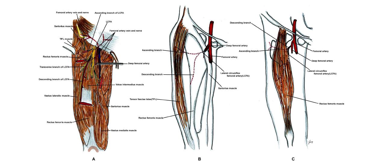 (A) Schematic drawings of lateral circumflex femoral artery (LCFA) and its branches, femoral nerves and its related muscular anatomies, and (B) tensor fascie latae musculocutaneous flap, and (C) rectus femoris myocutaneous flap.