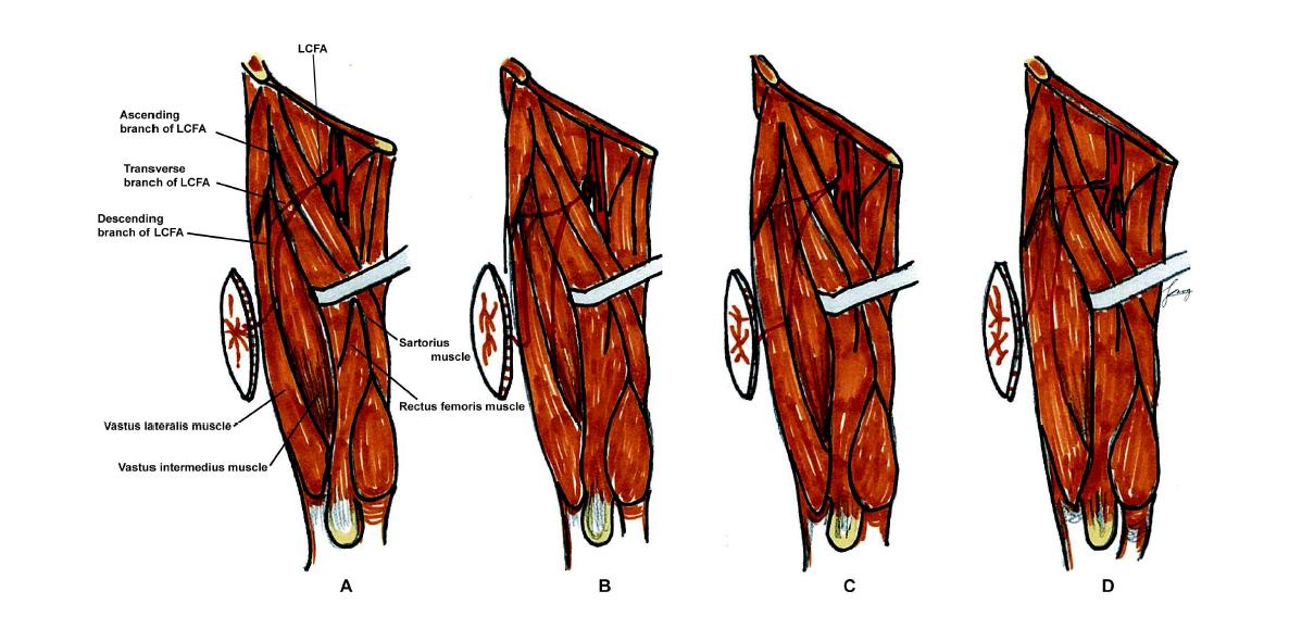 (A) Myocutaneous perforator from the descending branch of the lateral circumflex femoral artery (LCFA), penetrating the vastus lateralis with an intramuscular length of ∼5 cm in 57% of cases. (B) Myocutaneous perforator from the transverse branch of the LCFA, penetrating the vastus lateralis with an intramuscular length of ∼7 cm in 27% of cases. (C) Septocutaneous perforator from the descending branch of the LCFA, penetrating the intermuscular septum between the vastus lateralis and retus femoris with a length of ∼4 cm in the septum in 11% of cases. (D) Septocutaneous perforator from the transverse branch of the LCFA, penetrating the intermuscular septum formed by the rectus femoris, vastus lateralis, and tensor fascia lata (TFL) with a length of ∼8 cm in the septum in 5% of cases.