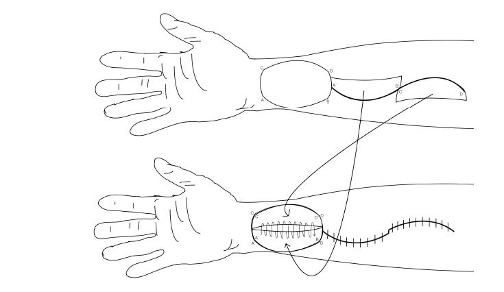 Schematic drawings of RFFF closure by using two local wavy skin grafts, each curvature of A to B, C to D is compatible that of A’ to B’ , C’ to D’ .