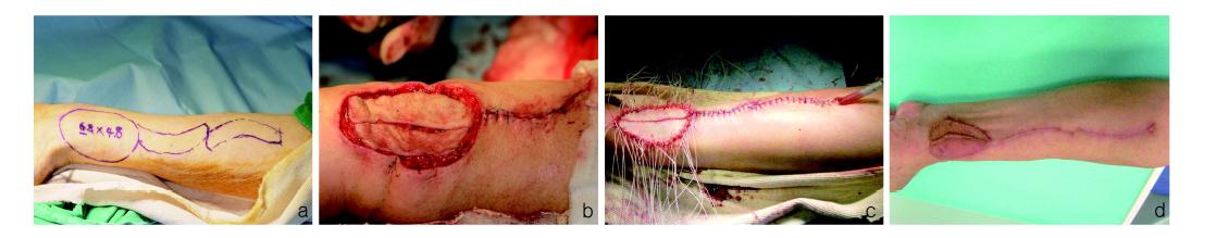 Procedures of radial forearm free flap (RFFF) closure by using two local wavy skin grafts.