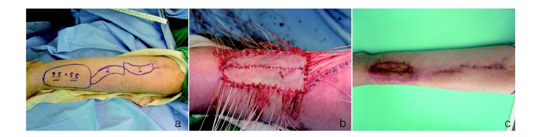 Procedures and postoperative appearance after long rectangular shaped RFFF design,