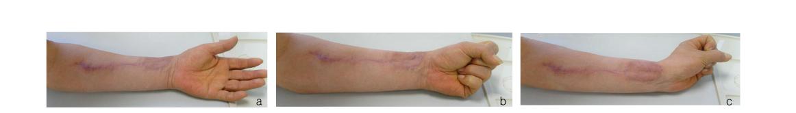 Postoperative healing appearances after 6 months, (a) normal appearance with finger extensions (b) appearance with clenched fists (c) full range of hand extension with clenched fists.