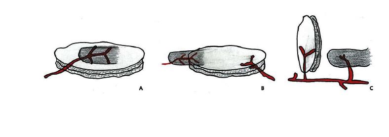 Schematic drawings of perforators to the skin territories based on their primary source of vascularization. A. composite flap, B. conjoined flap, C. chimeric flap.