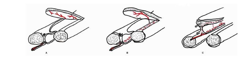 Different schematics of vascularization in fasciocutaneous flaps, A, multiple fasciocutaneous vessels entering at the base of the flap, B. single fasciocutaneous perforator, C. multiple small perforators from a main source vessel along a fascial septum between muscles.