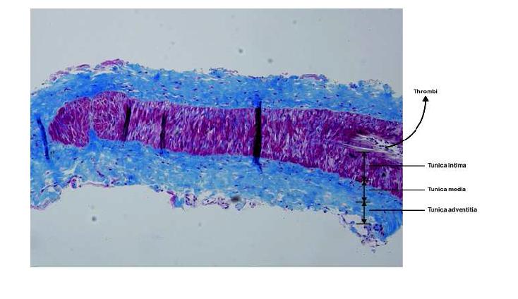 Photomicrograph shows longitudinal section of SIEA in sham group stained with Masson`s trichrome, magnification x100. Some thrombi with tunica intima, media, and adventitia, were shown.