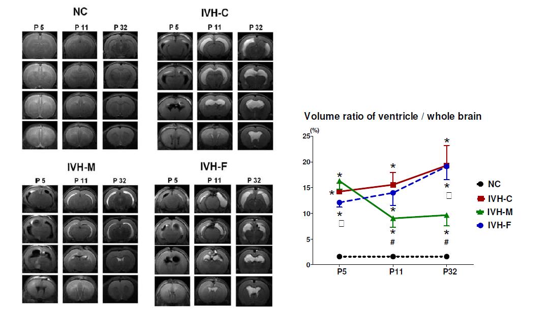 Serial changes of volume ratio of ventricles to whole brain