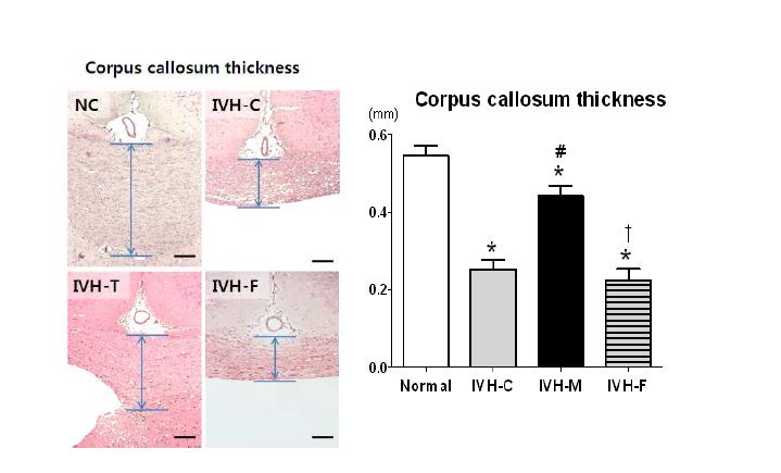 Corpus callosal thickness after IVH