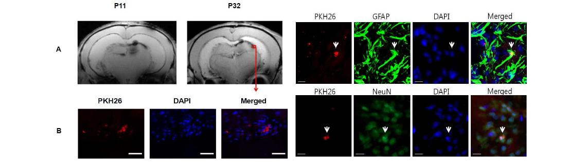 Confirmation of donor cells in the in vivo brain MRI and periventricular tissue and differentiation