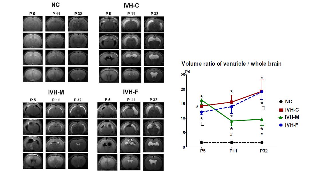 Serial changes of volume ratio of ventricles to whole brain