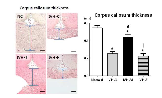 Corpus callosal thickness after IVH