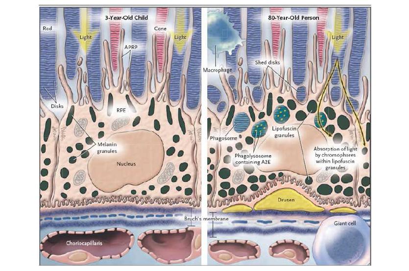3세 유아와 80세 노인의 망막모습.
