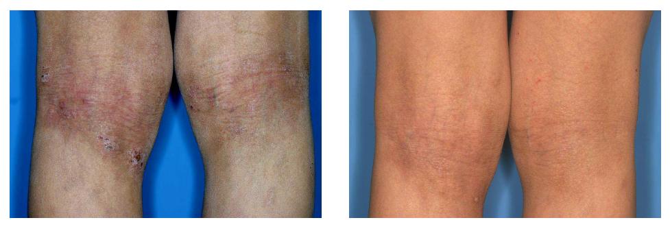 치료 시작전(왼쪽)에 비해 12주간의 치료후(오른쪽)의 아토피 피부염 병변이 호전된 것을 볼 수 있다(환자 No. 7).