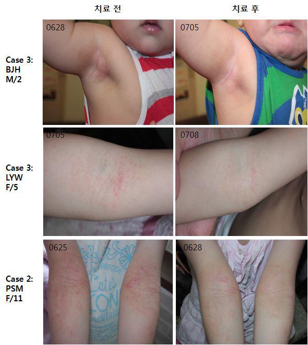 EffectsofCBWEontheclinicalsignsofatopicdermatitisinpatients