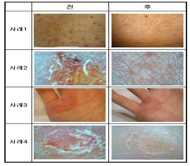 아토피 개선효과 판정.
