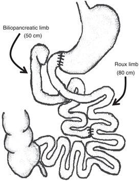 Schematic procedure of duodenal bypass surgery