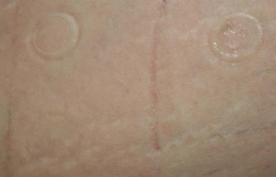 Photograph of patch test of the emulsion containing ANM cream