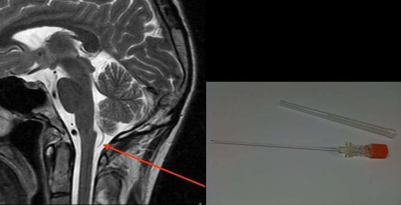 Stylet is injected into cerebellomedullary cistern between occipital bone and C1 vertebral body (모식도).
