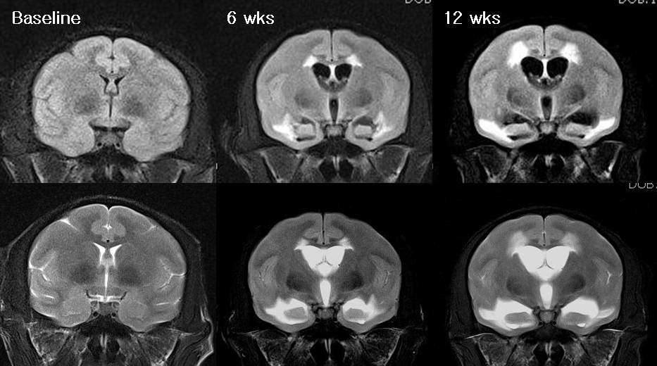 Serial FLAIR and T2 coronal images of higher dose group show ventricular enlargement with periventricular white matter and hippocampal complex signal change.