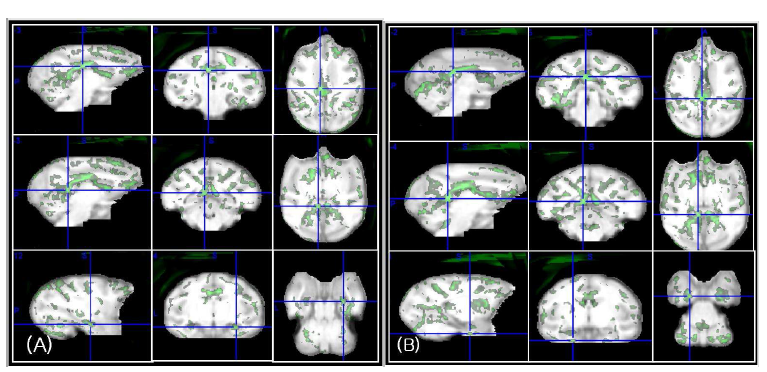 SPM analysis of the effect of ICV-STZ on brain metabolism measured by FDG-PET. Green voxels indicate brain regions where significant hypometabolism was observed compared with the baseline (p<0.01, uncorrected for multiple comparison). A: baseline vs 6 weeks, B: baseline vs 12 weeks.