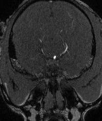 Axial MRA source image shows high signal intensity representing basilar artery and posterior cerebral artery. There is no singal intensity suggesting ICA (internal carotid artery).