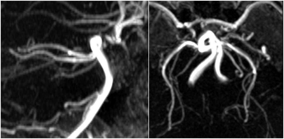3T MRA show collateral circulation (diminished MCA and ACA) via P-com from posterior circulation. There were no signal intensities of ICAs at both side.