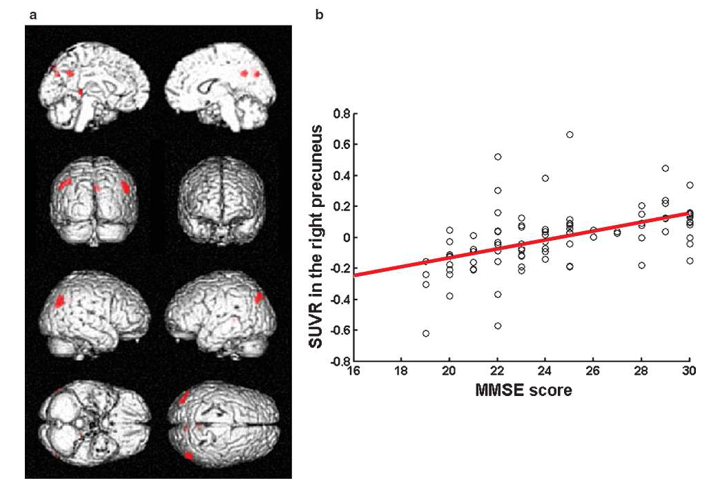 Brain areas of positive correlation between the regional [18F]-fluorodeoxyglucose uptake and Mini-Mental State Examination (MMSE) score