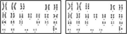 CFC 증후군 역분화줄기세포주의 핵형 (좌:② 우:⑦)
