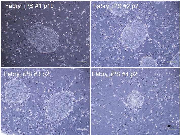 파브리병 환자 체세포에서 유래한 파브리병 역분화 줄기세포