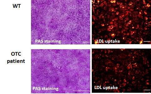 OTC 결핍증 환자(KJH) 역분화줄기세포에서 분화한 간세포에서의 PAS staining 및 LDL uptake 확인