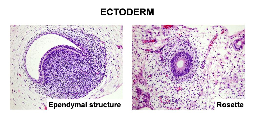 정상 역분화줄기세포로부터 형성된 teratoma - ectoderm 계열