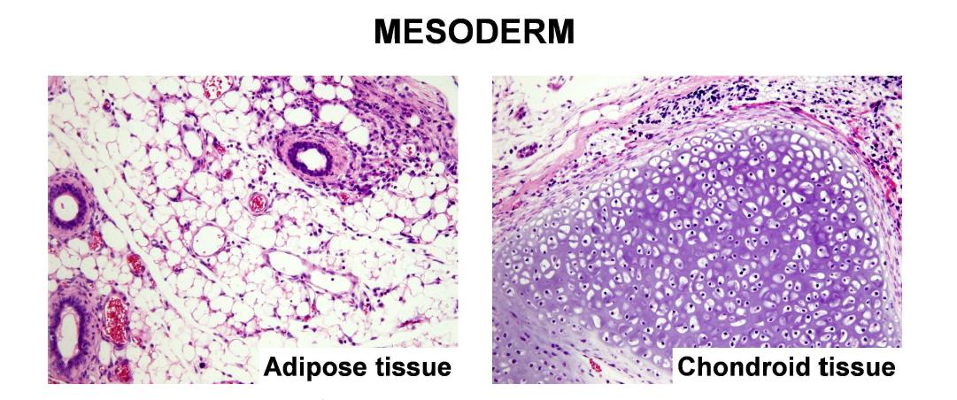 정상 역분화줄기세포로부터 형성된 teratoma - mesoderm 계열