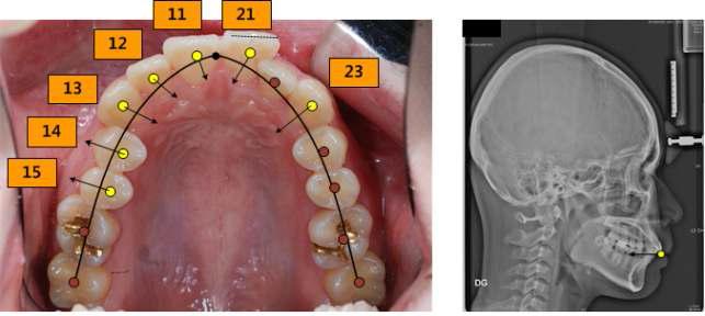 부정교합 Class II에서 교정치료를 위하여 역계획한 치아의 이동경로