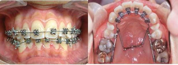 기존의 치아교정 방법