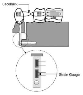 영국의 Khambay와 아일랜드의 Milett 공동연구로 2개의 strain gauge를 이용하여 교정력 측정을 시도함