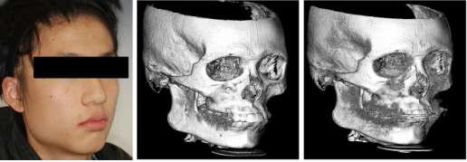 실제 환자의 사진(오른쪽), 교정기 장착 전(중앙)과 발치 및 교정기 장착 후(오른쪽, 교정와이어를 확인할 수 있음)의 악안면 CT 데이터로부터 Vworks 프로그램을 이용하여 3D로 재구성한 예