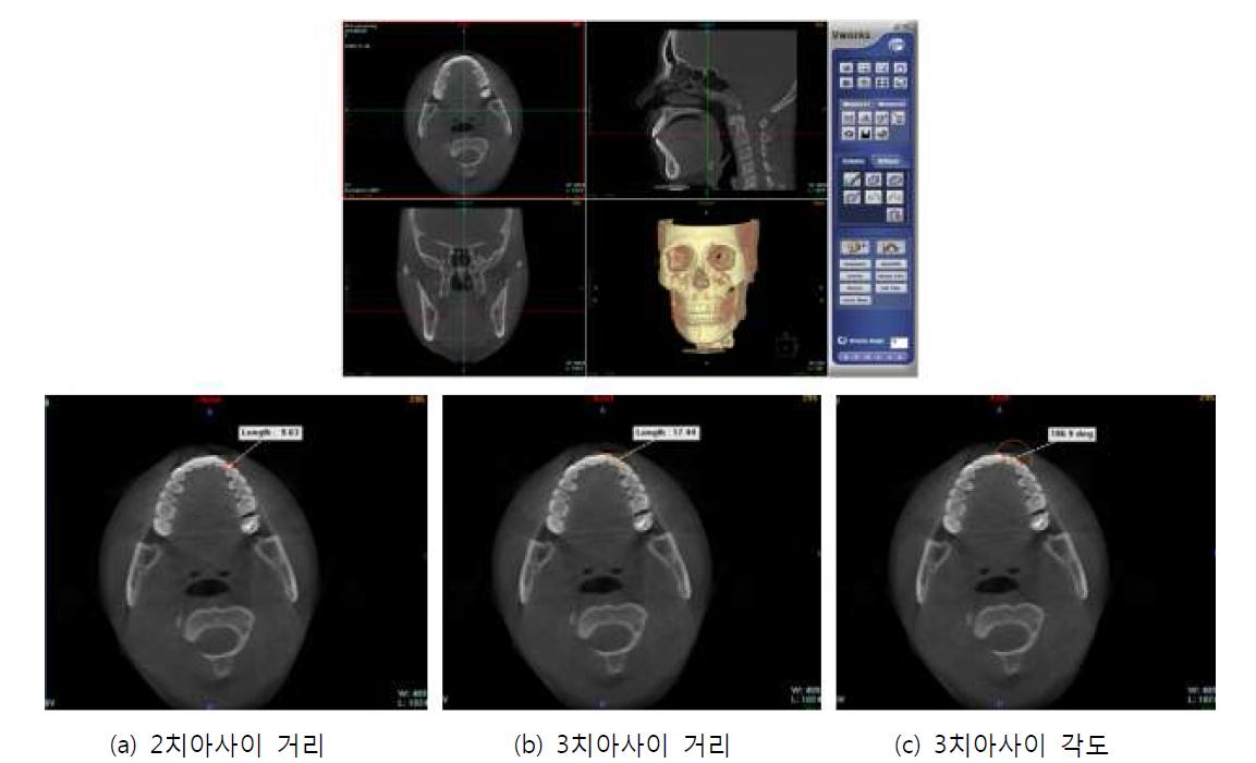 vWorks에서 환자 CT로부터 2개와 3개 치아사이의 거리와 각도 측정
