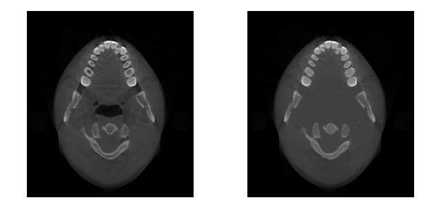 환자 CT 영상 원이미지(좌)와 imfilled 처리된 이미지(우)