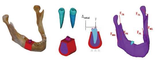 (좌) 해석을 위하여 제작한 3D 유한요소모델과 해당 segment 부분에서 하나의 독립된 치아와 PDL, cortical 부분 (적색)과 치밀골 부분(보라색), (우) loading과 경계조건 설정 부분
