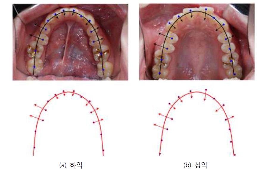 최적화 알고리즘을 적용하여 사진으로부터 계산된 교정치료 시 치아의 이동 방향