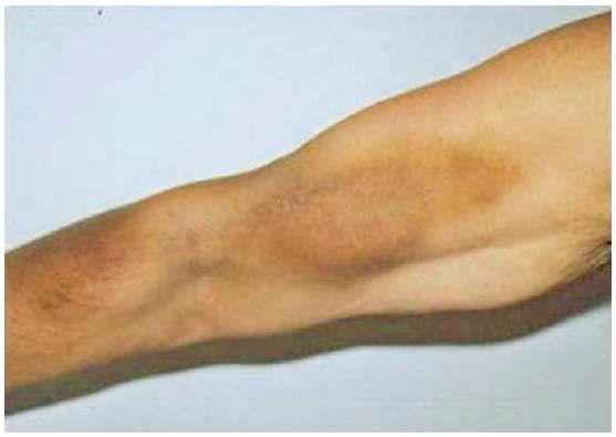 mTHPBC의 정맥 주사 이후 팔에서 발생된 염증성 과색소침착