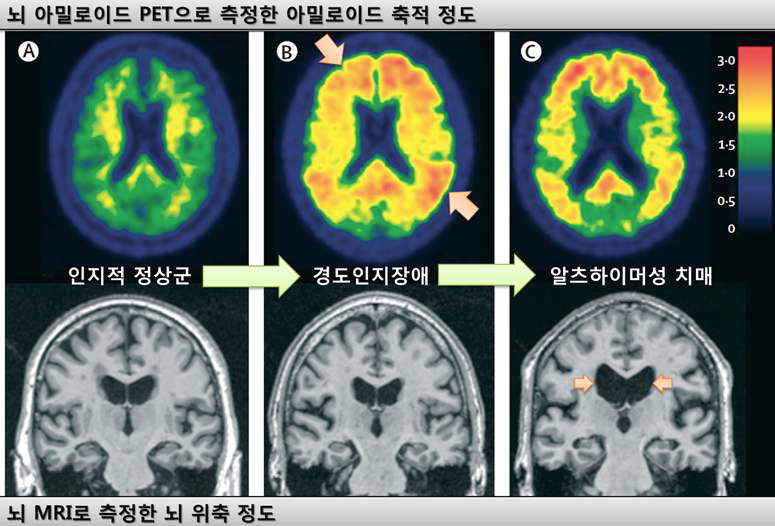 뇌영상을 통한 알츠하이머성 치매의 조기진단