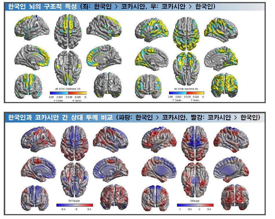한국인과 코카시안(서양인) 간 대뇌피질 두께 비교 결과