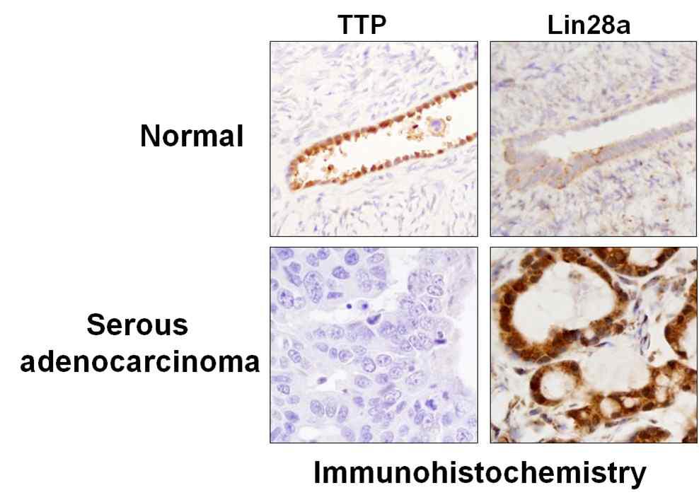난소암조직의 약 280정도가 coating 된 2개 슬라이드로부터 TTP 및 Lin28 발현을 면역염색법으로 분석.
