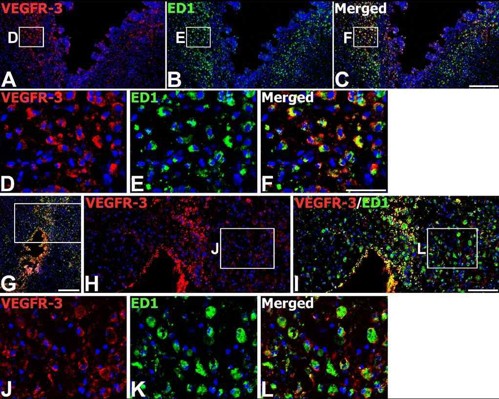 Expression of VEGFR-3 protein in brain macrophages on day 3 after transplantation of MSCs. Double-labeling with VEGFR-3 and ED1 at the graft site