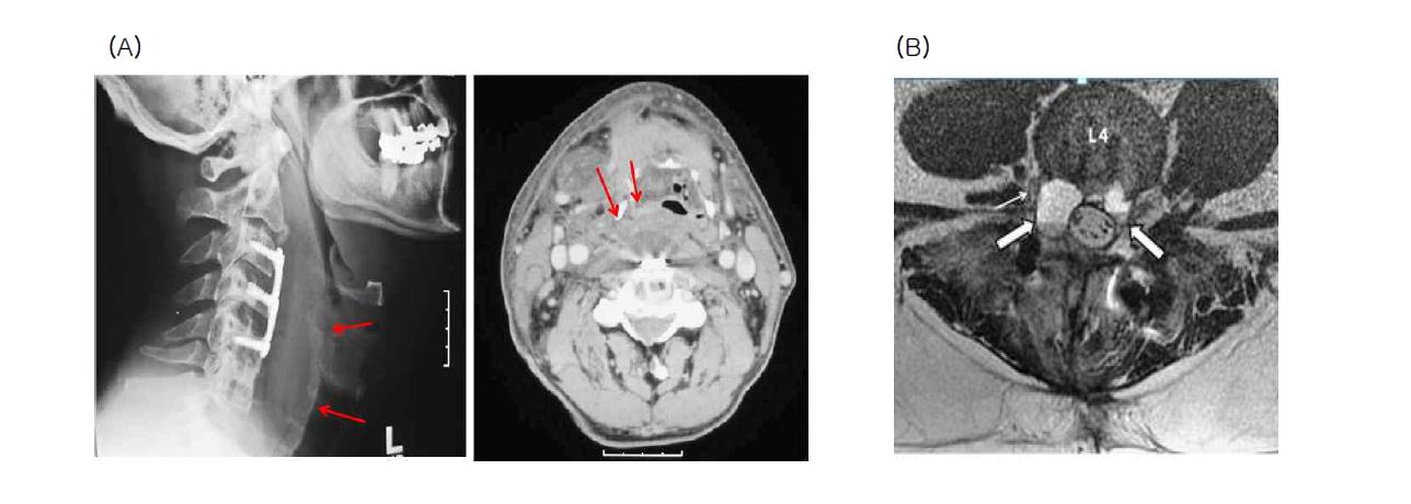 (A) 골형성 단백질을 이용한 경추 전방 유합술 후 발생한 목 부위의 심한 부종. 단순 방사선 사진상 심한 부종 소견 (좌, 화살표)과 CT 사진 상 부종으로 인해 기관지가 압박되어 있는 것을 보여주고 있음 (우측). (B) 이식된 골형성 단백질 주변에 있는 신경에 발생한 염증 (화살표)